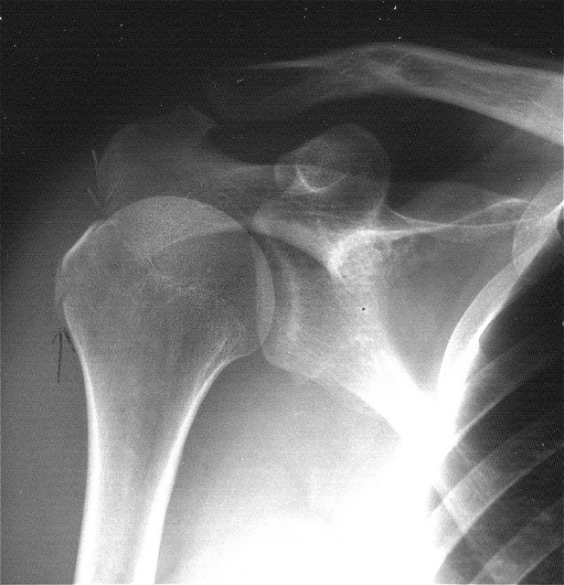 Shoulder fracture (by reverbca on flickr)